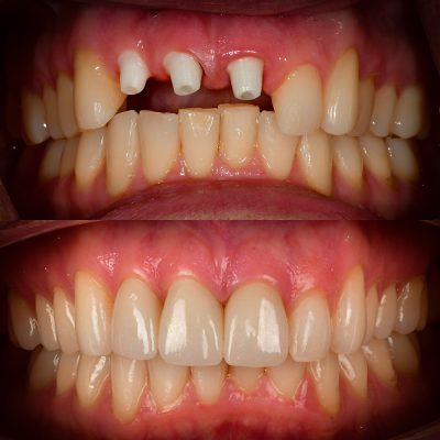 Front Tooth Ceramic Implant Before & After - Best Ceramic Implant Dentist USA Dr. May