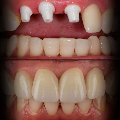 Front Tooth Ceramic Implant Before & After - Best Ceramic Implant Dentist USA Dr. May