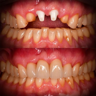 Front Tooth Ceramic Implant Before & After - Best Ceramic Implant Dentist USA Dr. May