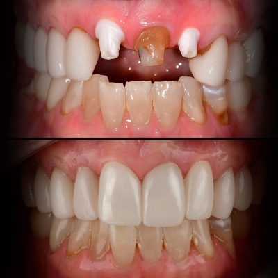 Front Tooth Ceramic Implant Before & After Top Ceramic Implant Dentist USA Dr. May