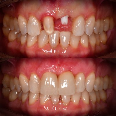 Front Tooth Ceramic Implant Before & After Top Ceramic Implant Dentist USA Dr. May