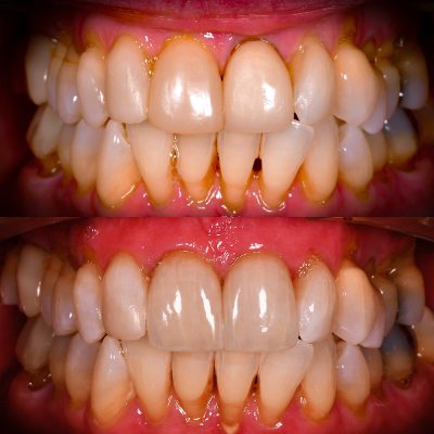 y Before After Front Tooth Crry wns Cosmetic Holistic Dentist Dr. May