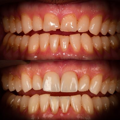 y Cosmetic Dentistry Before After Veneers Holistic Dentist Biological Dentist