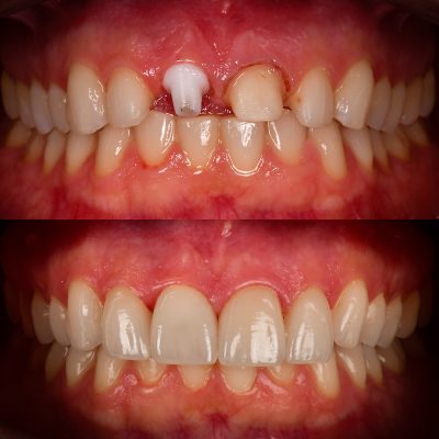 y Front Tooth Implant Photo Before and After Zirconia Implants