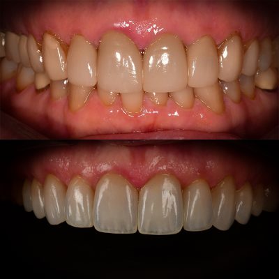 y Veneers Before After Holistic Cosmetic Dentistry Smile Makeover Best Biological Dentist