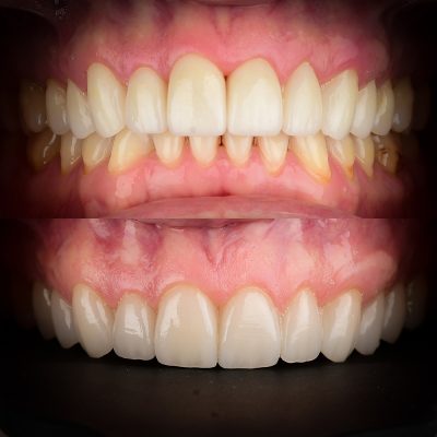 y Veneers Before After Photos Fixing Bad Veneers Cosmetic Dentist