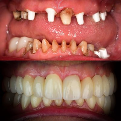 y Zirconia Implant Photos Before After Full Mouth Ceramic Implants