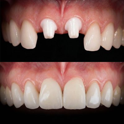 Front Tooth Zirconia Implant Before & After Best Zirconia Implant Dentist USA Dr. May Front Tooth Implant
