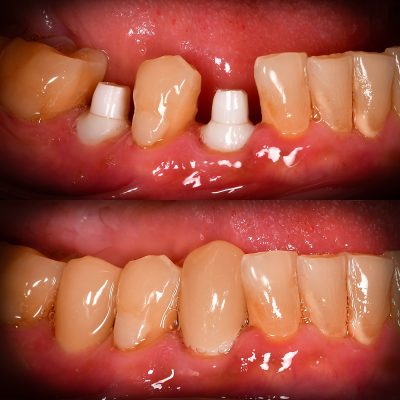 Zirconia Dental Implant Before and After Posterior