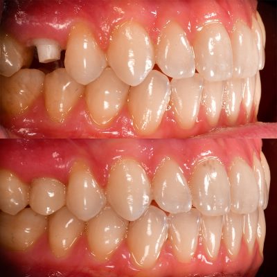 Zirconia Dental Implant Before and After Posterior