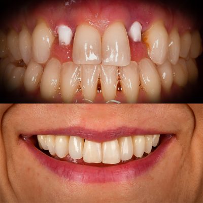 Front Tooth Implants Zirconia Dental Implant Before and After Front Tooth Implant Before and After Dr. May Best Ceramic Implant Dentist
