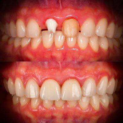 Front Tooth Implant Zirconia Dental Implant Before and After Front Tooth Implant Before and After Dr. May Best Ceramic Implant Dentist
