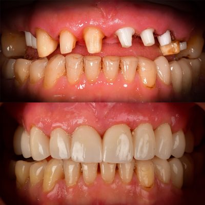 Front Tooth Ceramic Implants: Zirconia Dental Implant Before and After Front Tooth Implant Before and After Dr. May Best Ceramic Implant Dentist Full Mouth Biological Dentist