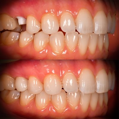 Ceramic Implants Before and After Molars Root Canal Removal by Best Ceramic Implant Dentist USA Zirconia Implant Photos