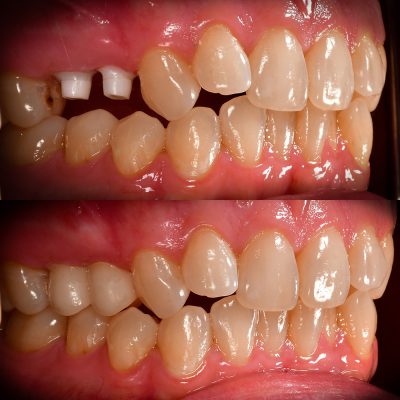Ceramic Implants Before and After Molars Root Canal Removal by Best Ceramic Implant Dentist USA Zirconia Implant Photos