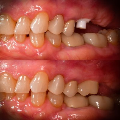Ceramic Implants Before and After Molars Root Canal Removal by Best Ceramic Implant Dentist USA Zirconia Implant Photos